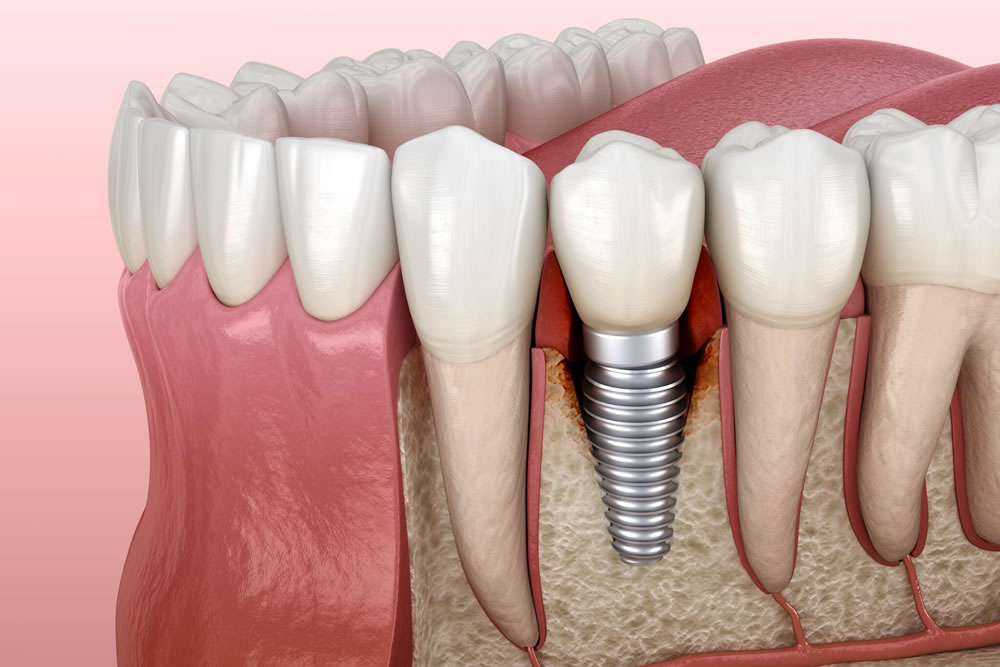 インプラントの仕組み