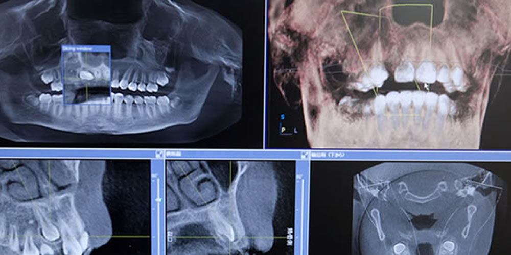 インプラントの安全性