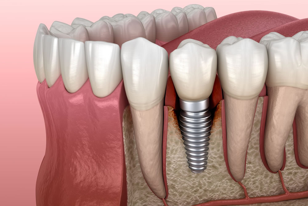 インプラント治療とは？
