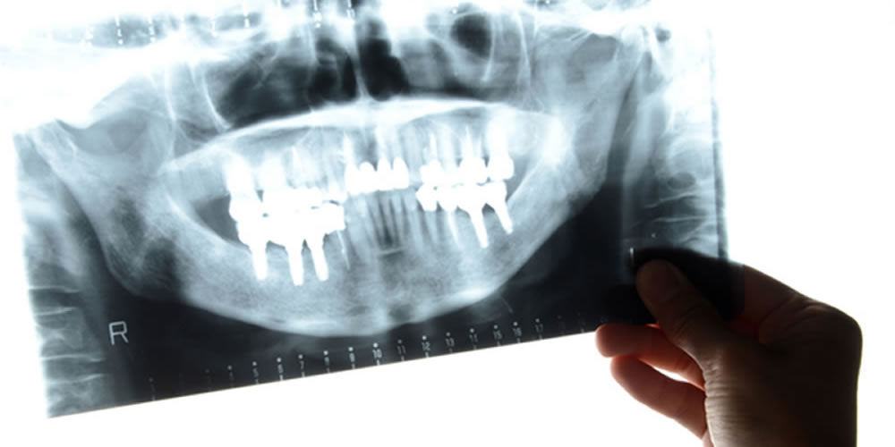 インプラント治療の流れをわかりやすく解説