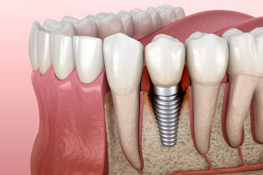 治癒期間（骨との結合）