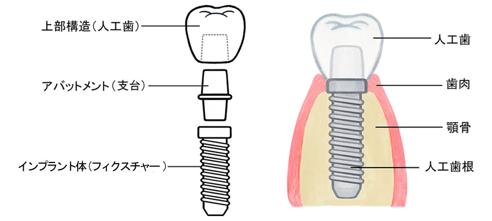 インプラントの構造